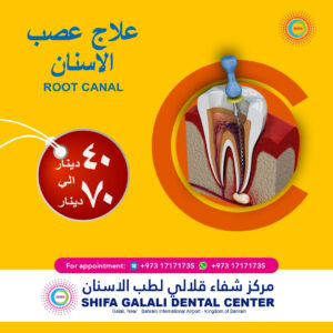 Root Canal Treatment – 40 to 70 BHD