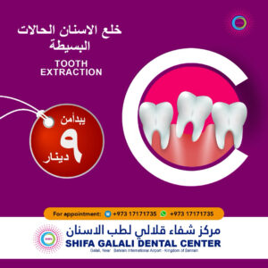 Simple Tooth Extraction